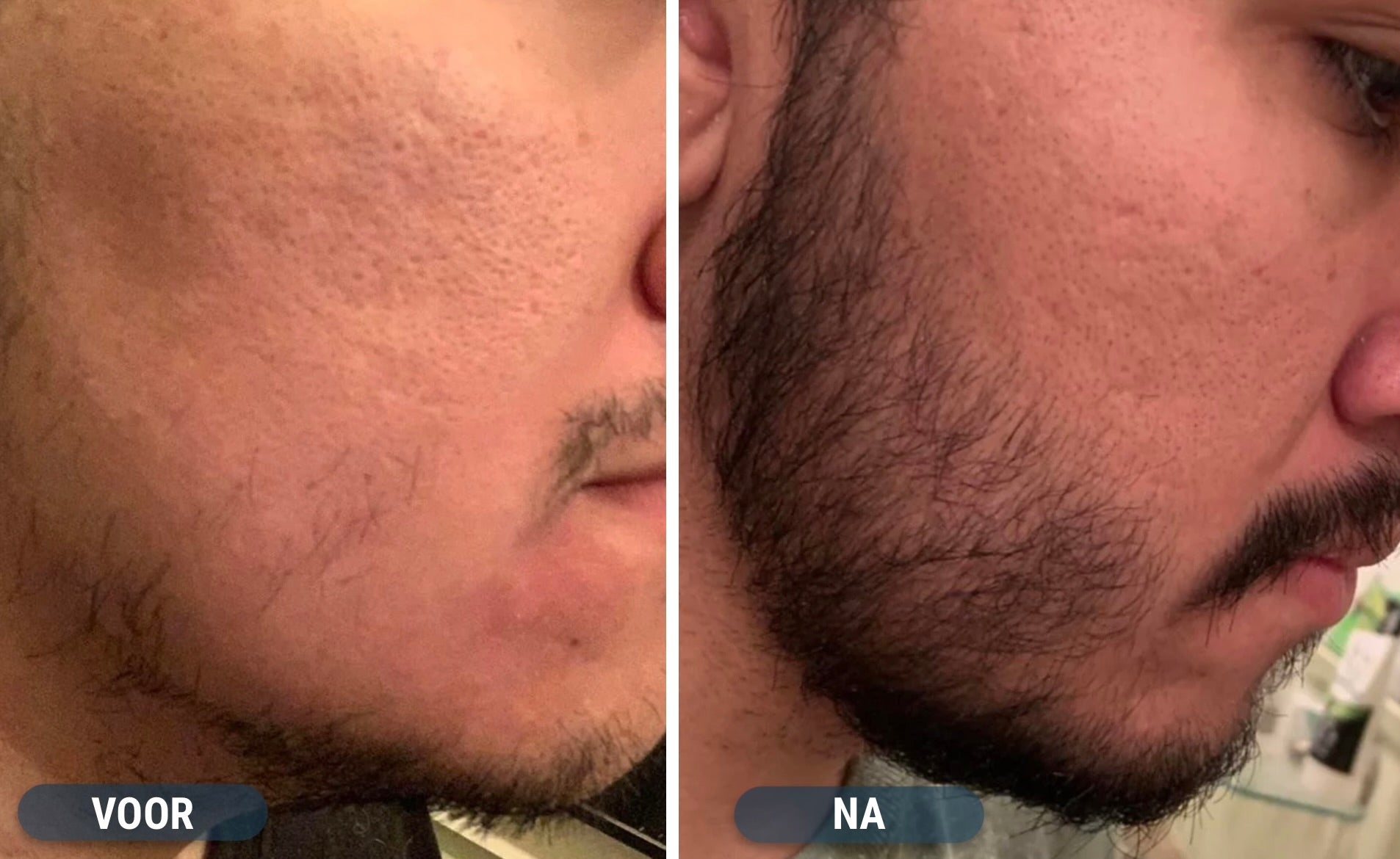 Minoxidil resultaten