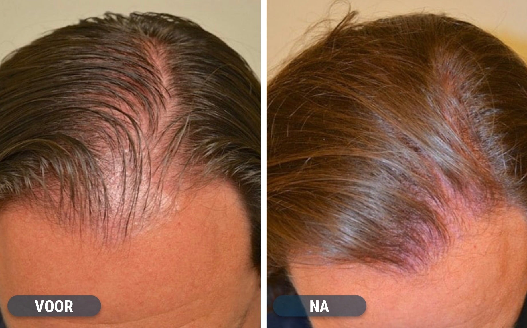 Minoxidil resultaten