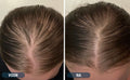 Minoxidil vrouw resultaten